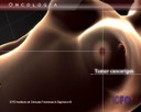  recerca sobre la detecció i el tractament del càncer per mitjà de nanopartícules d'or il·luminades amb làser